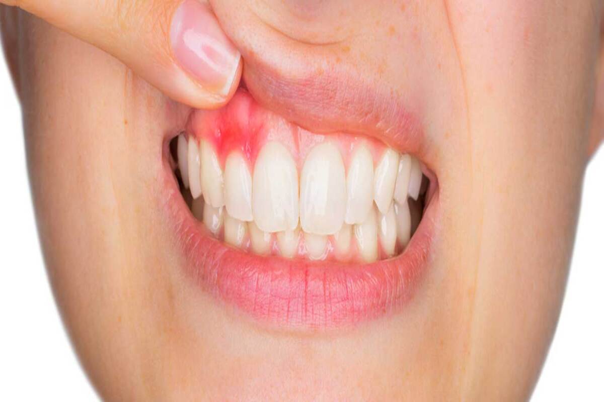Diş eti Hastalıkları Tedavisi(Periodontoloji)